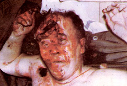 The corpse of Bosnian Serb civilian Radivoje Lukic, 59. The Bosnian Muslim paramilitaries “The Mosque Doves” or “Dzamijski Golubovi”, murdered him with an axe to the head on October 8, 1992 in Klisa.