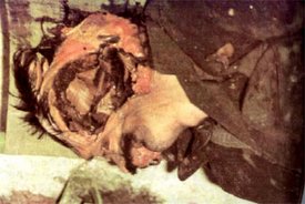Sarajevo: The body of Bosnian Serb Nenad Beribaka. The Bosnian Muslim forces mutilated his body after killing him by extracting his brain.